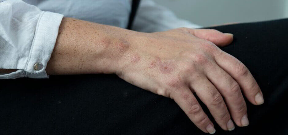 % need to know when bed bug bites need to know when bed bug bites